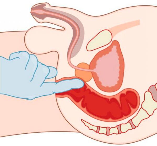 Stimulation of the G-spot in men through the anus